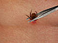 How To Remove a Tick