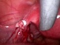 Tubal Ligation
