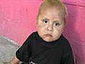 Malnutrition in Guatemala