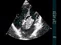 Left Atrial Myxoma