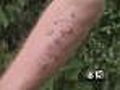 Poison Ivy Cases Up This Summer