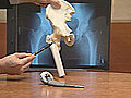 Minimally Invasive Total Hip Replacement