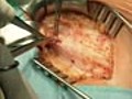 Open Inguinal Hernia Repair Surgery