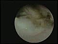 Hysteroscopic Myomectomy