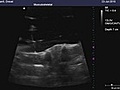 Sagittal View of Axial Compression of Lumbar