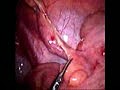 Laparoscopic Appendicectomy (Appendectomy)