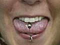 Tongue piercing poses problems