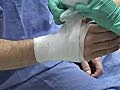 Volar Slab CAST Application
