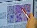 Mayo Clinic Turning Viruses Into Cancer Killers