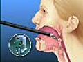 Robotic Tongue Cancer Surgery