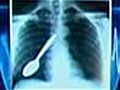 Spoon stuck in lung