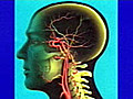 Post-Stroke Patient Care