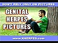 Female Genital Herpes Pictures