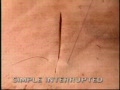 Interrupted Sub-Dermal Sutures