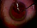 Cataract Surgery 3