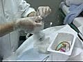 Female Foley Catheterization Technique
