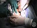 Coronay Artery Bypass Heart Surgery