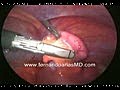 Laparoscopic Appendectomy