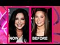 Did Bristol Palin Get Plastic Surgery?