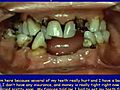 Lecture 8 - Two-implant supported overdenture treatment,  Dental Prosthodontics