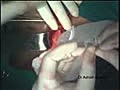 Hernia Repair with Prolene Hernia System