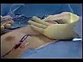 Breast Augmentation Plastic Surgery Video