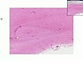 Virale Enzephalitis Histopathologie