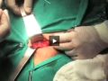 Direct inguinal hernia repair