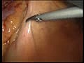 Laparoscopic anterior resection for cancer colon