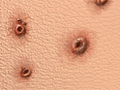 Symptoms of Chickenpox