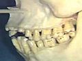 Lecture 32 - Nerve Supply to Teeth; Maxillary Sinus,  Human Anatomy Dissection