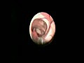 Endoscopic View of a Ventricular Cyst