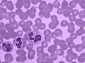 Leukemia Explained