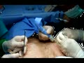 FUE hair transplant