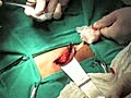 Direct Inguinal Hernia Repair