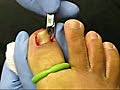 Ingrown Toenail Removal