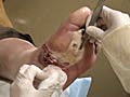 Debridement of an Infected Diabetic Foot Wound