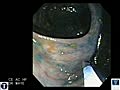 Chromoendoscopy During Ulcerative Colitis Surveillance