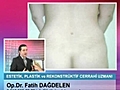 Liposuction Sonrasi Kilo Alinirmi?