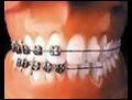 Ortodontik tedavi gören kisi nelere dikkat etmeli?