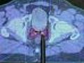 Radiation and Hormone Therapy Helps Treat Prostate Cancer