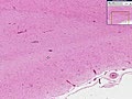 Viral Encephalitis Histopathology