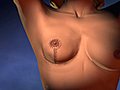 Procedure for Breast Lift Surgery
