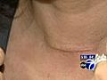 VIDEO: Thyroid cancer on the rise
