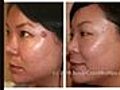 Laser Acne Scar Removal Treatment - Asian Patient