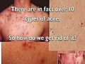 How To Get Rid Of Acne On Back