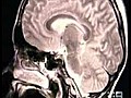 Vitamin B could fight Alzheimer’s