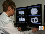 CAT scan lung cancer screenings cut deaths: study