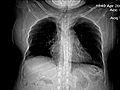 Lung Cancer: Lung Cancer Part 3