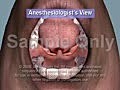 Endotracheal Intubation Sample Animation